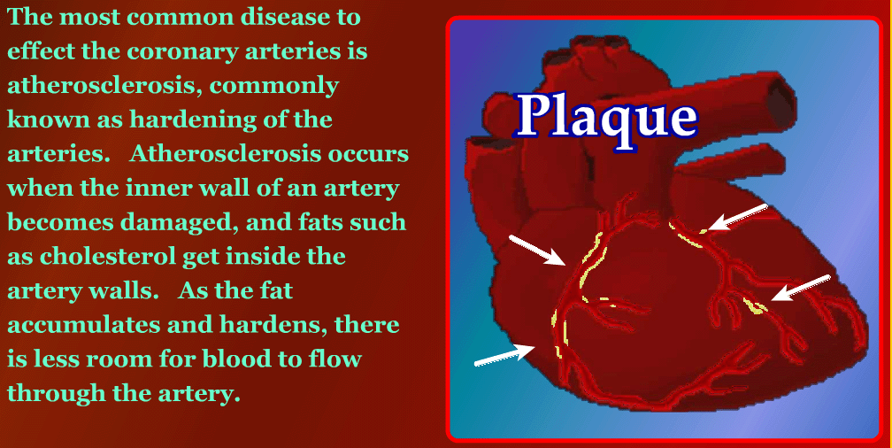 Plaque on your heart is bad
